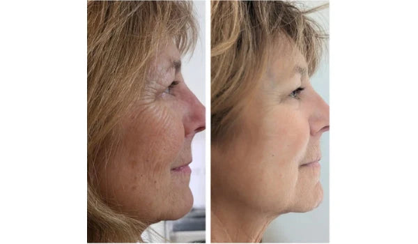Anti-Aging