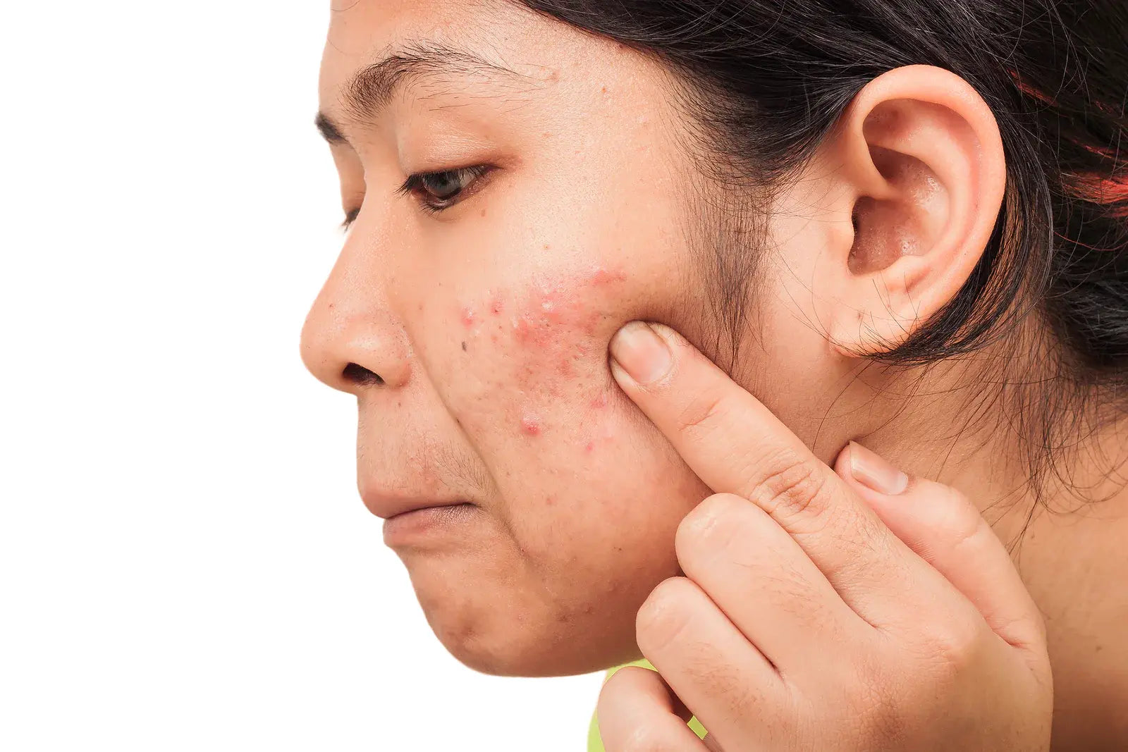 women with a lot of acne