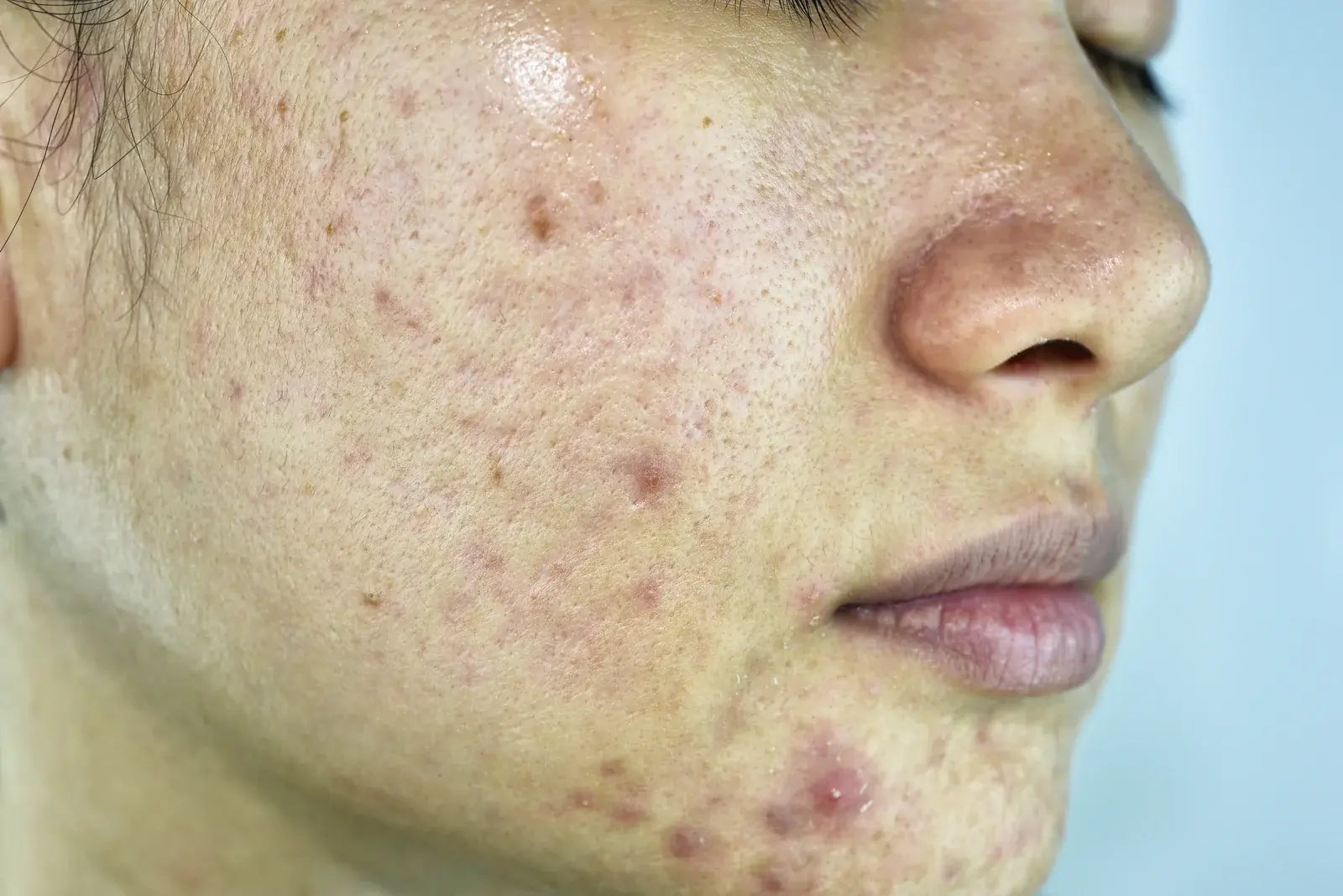 Acne Types and Acne Causes