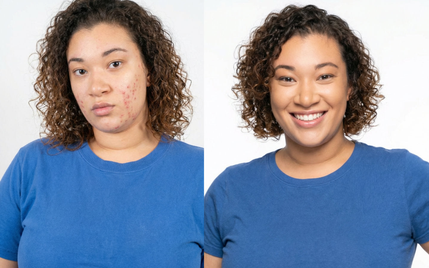 Clear Skin / Acne / Barrier restoring