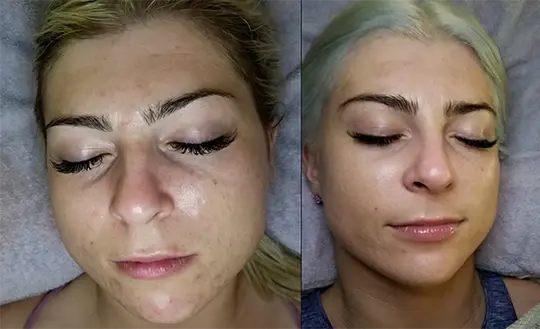 Clear Skin / Acne / Barrier restoring