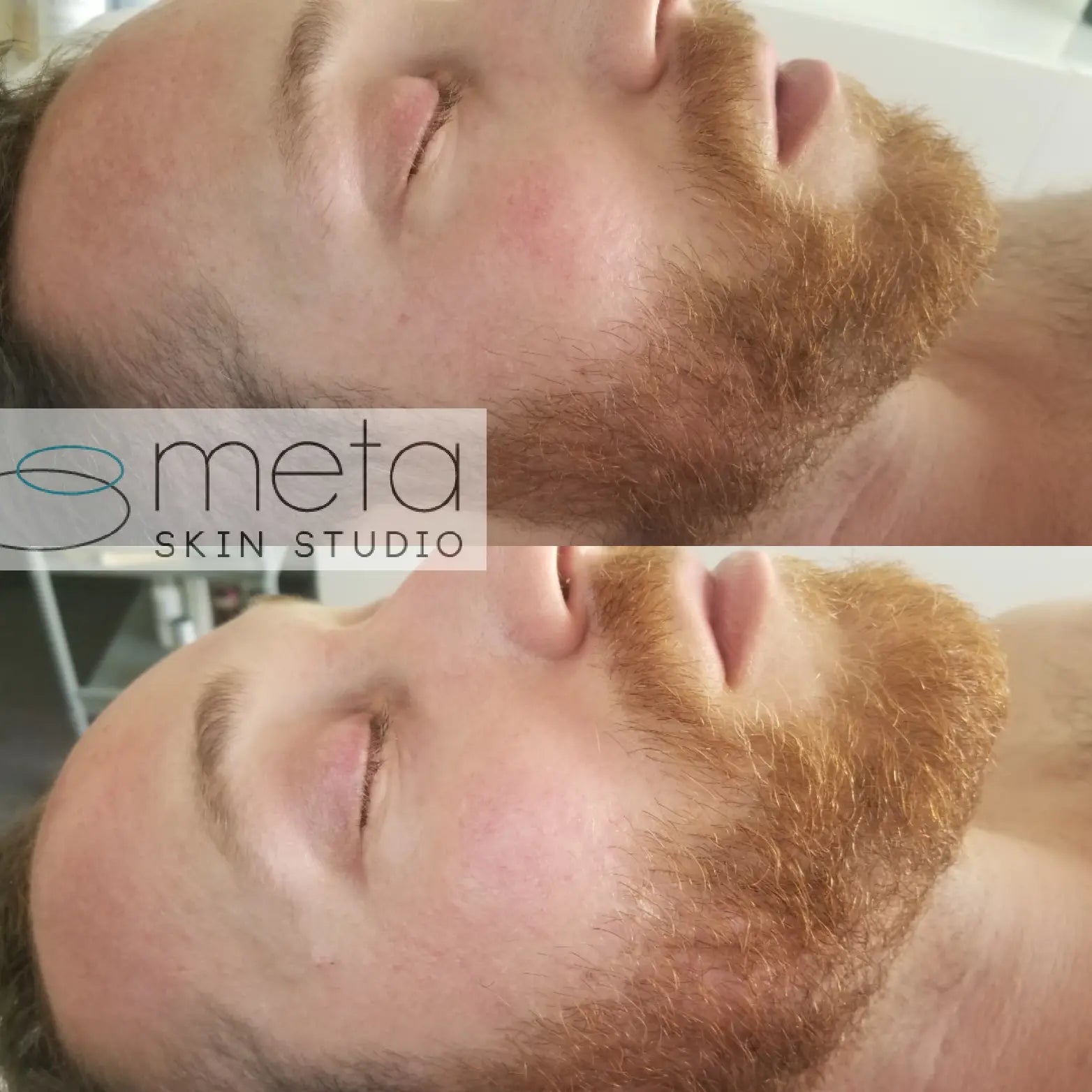 Male results Hydra derm facial