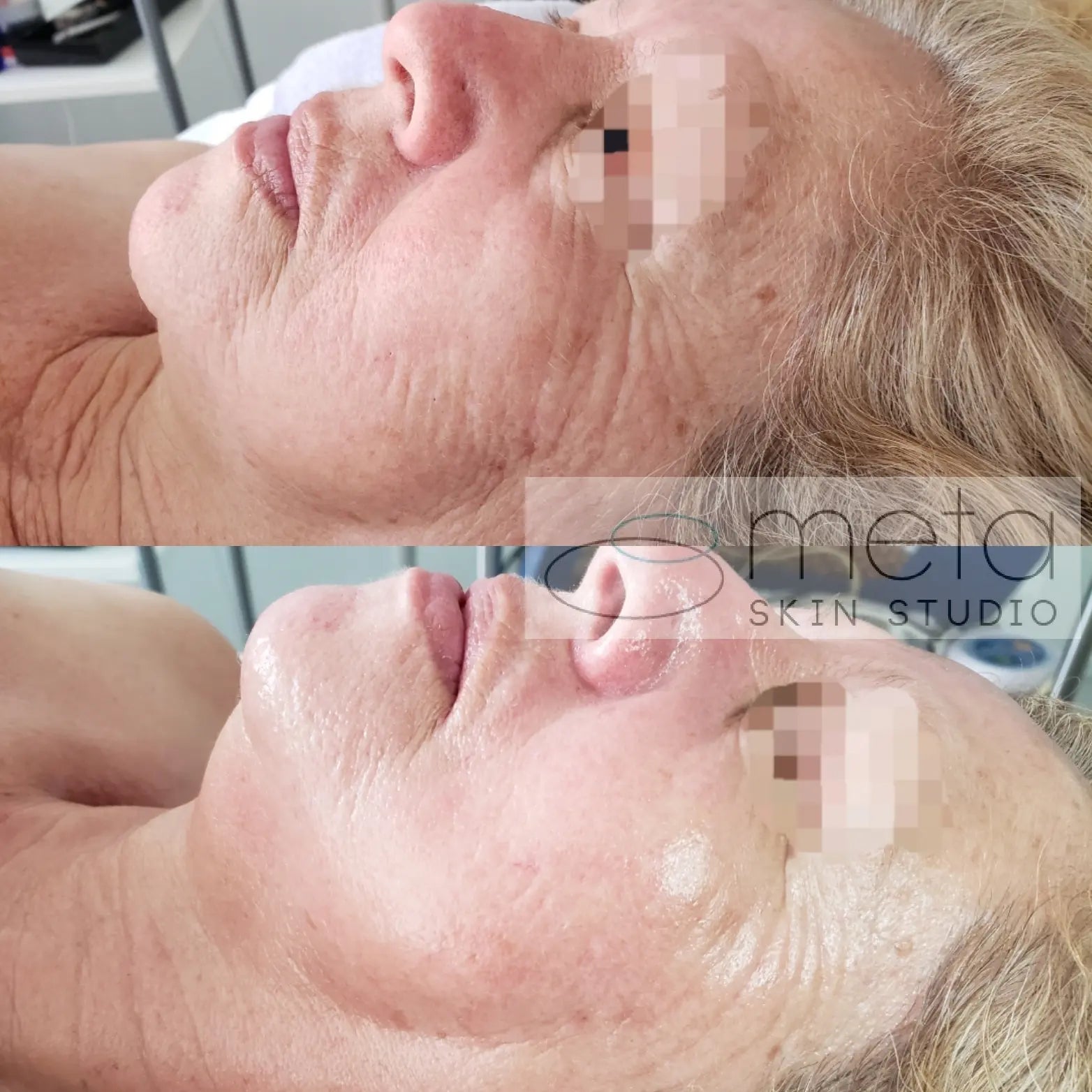 Kim skin transformation facial - Meta Skin Studio