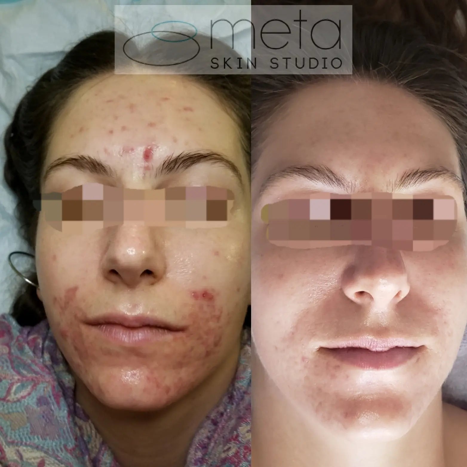 women results after clear skin program consultation