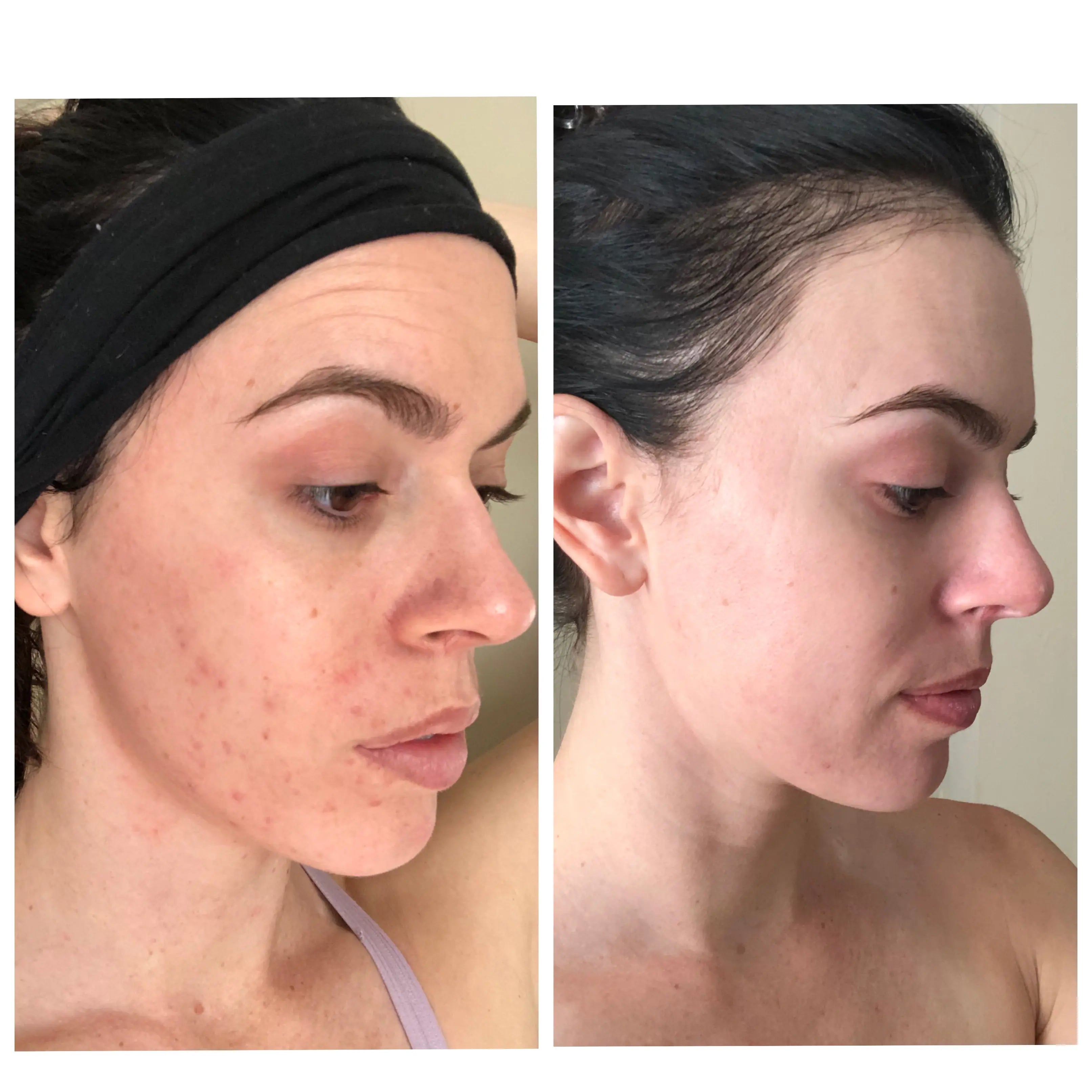 women results after clear skin program consultation