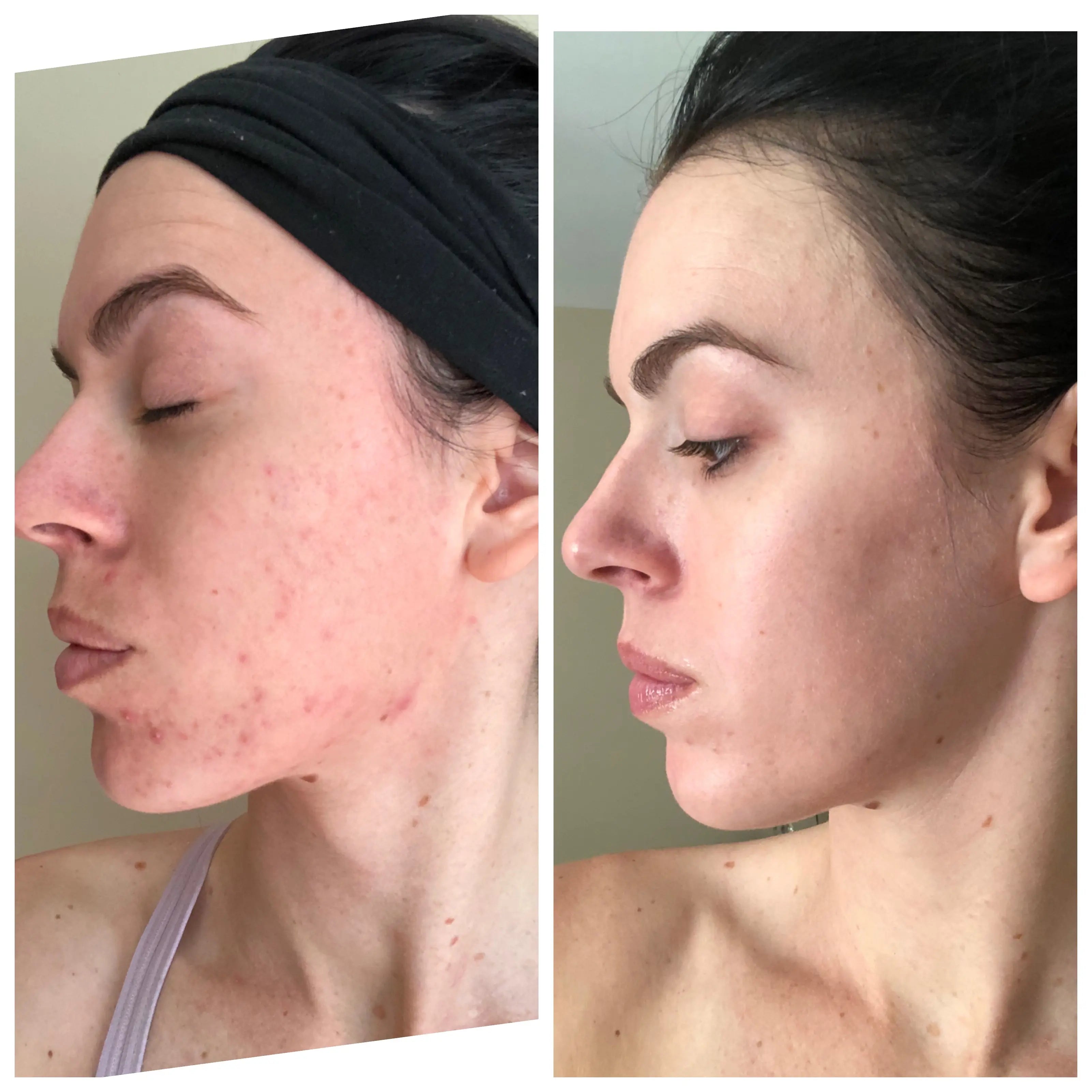 women results after clear skin program consultation