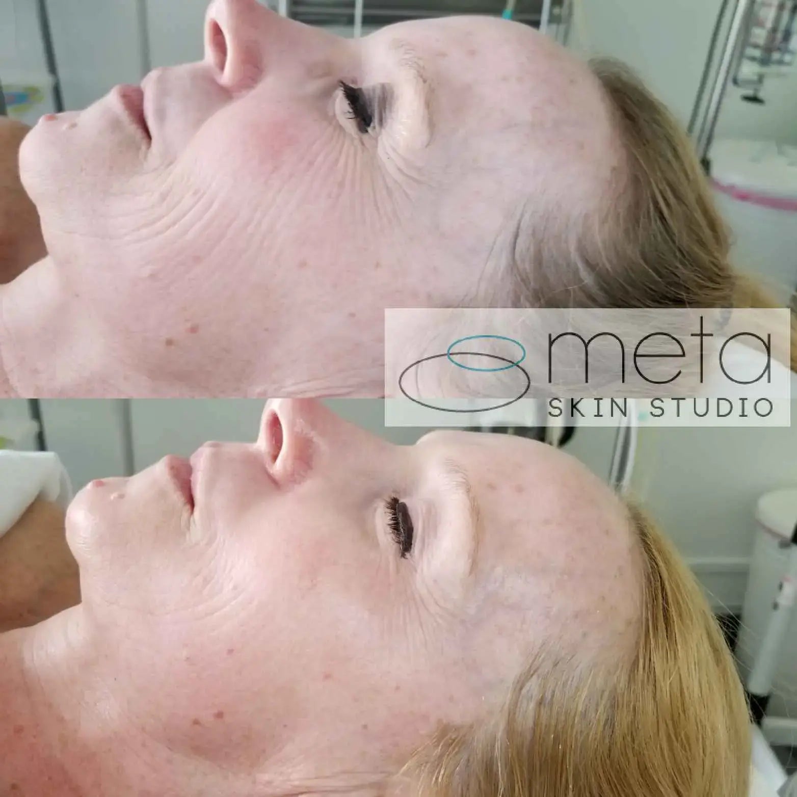 Women skin transformation facial - Meta Skin Studio